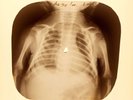 X-RAY CHILD USSR ROENTGEN  BONES RECORD ORIGINAL OLD RIBS 906