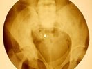 X-RAY USSR ROENTGEN BONES RECORD ORIGINAL OLD RIBS 901
