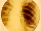 X-RAY USSR ROENTGEN BONES RECORD ORIGINAL OLD RIBS 900