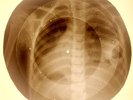 X-RAY CHILD USSR ROENTGEN  BONES RECORD ORIGINAL OLD RIBS 903