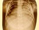 X-RAY CHILD USSR ROENTGEN  BONES RECORD ORIGINAL OLD RIBS 898