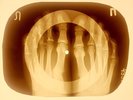 X-RAY FOOTS USSR ROENTGEN BONES RECORD 78 rpm ORIGINAL OLD RIBS 920