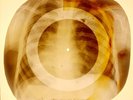 X-RAY CHILD USSR ROENTGEN BONES RECORD ORIGINAL OLD RIBS 922