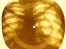 X-RAY USSR ROENTGEN BONES RECORD ORIGINAL OLD RIBS 980
