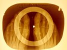 USSR X-RAY FOOTS ROENTGEN BONES RECORD ORIGINAL OLD RIBS 954