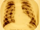 X-RAY USSR ROENTGEN BONES RECORD ORIGINAL OLD RIBS 982