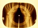 USSR X-RAY HANDS ROENTGEN BONES RECORD ORIGINAL OLD RIBS 997