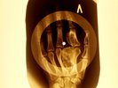 DAMAGE USSR X-RAY HAND ROENTGEN BONES RECORD ORIGINAL OLD RIBS 1