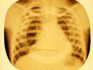 X-RAY USSR ROENTGEN BONES RECORD ORIGINAL OLD RIBS 996