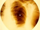 X-RAY USSR ROENTGEN BONES RECORD ORIGINAL OLD RIBS 26
