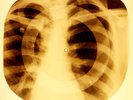 X-RAY USSR ROENTGEN BONES RECORD ORIGINAL OLD RIBS 993