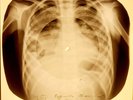 X-RAY CHILD USSR ROENTGEN BONES RECORD ORIGINAL OLD RIBS 964