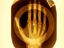 USSR X-RAY HAND ROENTGEN BONES RECORD ORIGINAL OLD RIBS 990