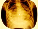 X-RAY USSR ROENTGEN BONES RECORD ORIGINAL OLD RIBS 14